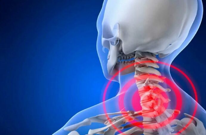 Gimdos kaklelio stuburo osteochondrozė