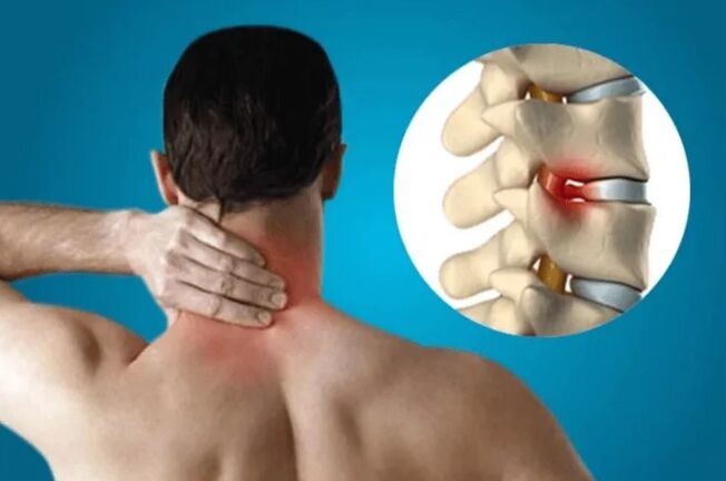 Stuburo osteochondrozė