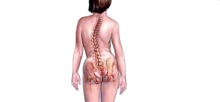 Osteochondrozė